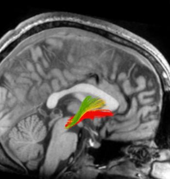 Fig.2 : coupe d’un IRM d’un cerveau humain. Les trois couleurs représentent des chemins liés à l’addiction. En rouge, les chemins liés à la récompense, en vert et jaune ceux assimilés aux réponses habituelles. 